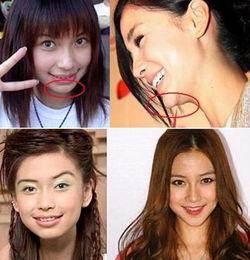 娱乐圈整容爆料